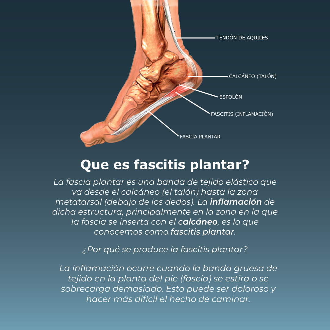Qué es la fascitis plantar